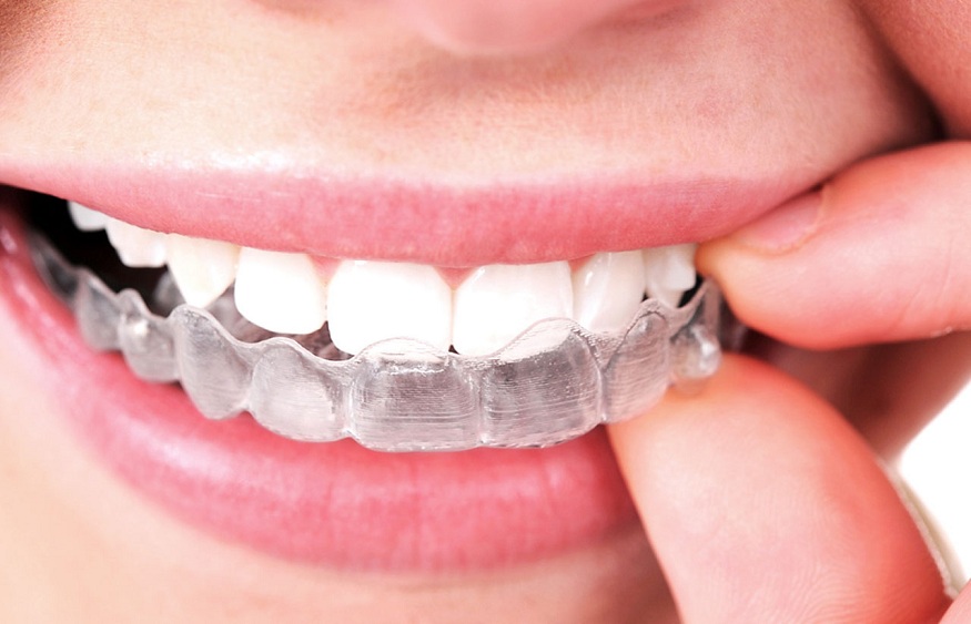 makeO toothsi Aligners